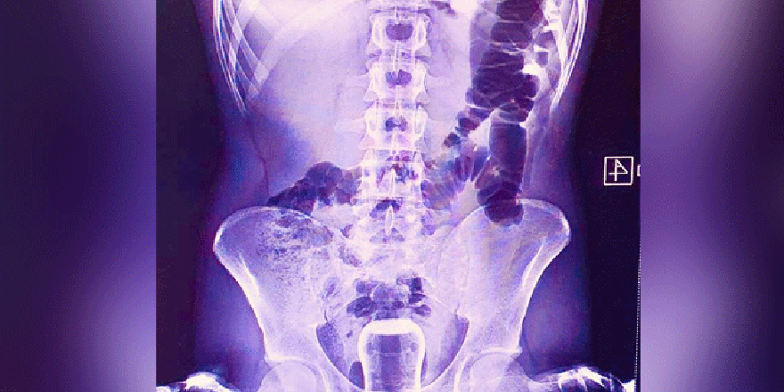 Çay bardaklı hacamat kazası