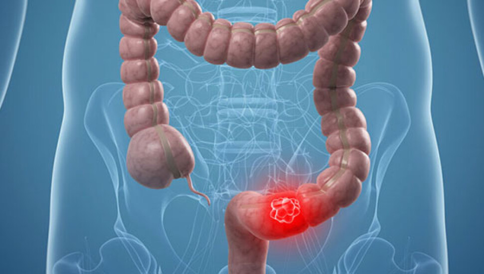 Kalın bağırsak kanseri tarama programları ile önlenebiliyor