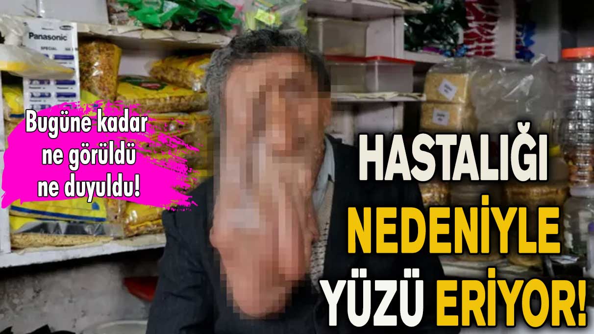 Hastalığı nedeniyle yüzü eriyor! Görülmemiş, duyulmamış hastalık