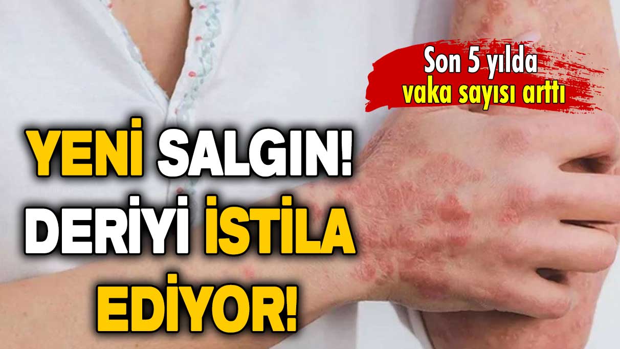 Türkiye’nin yeni salgını: Deriyi istila ediyor!