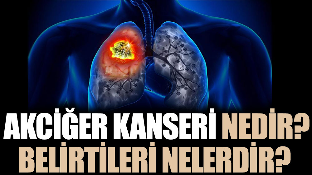 Akciğer kanseri nedir? Belirtiler nelerdir?