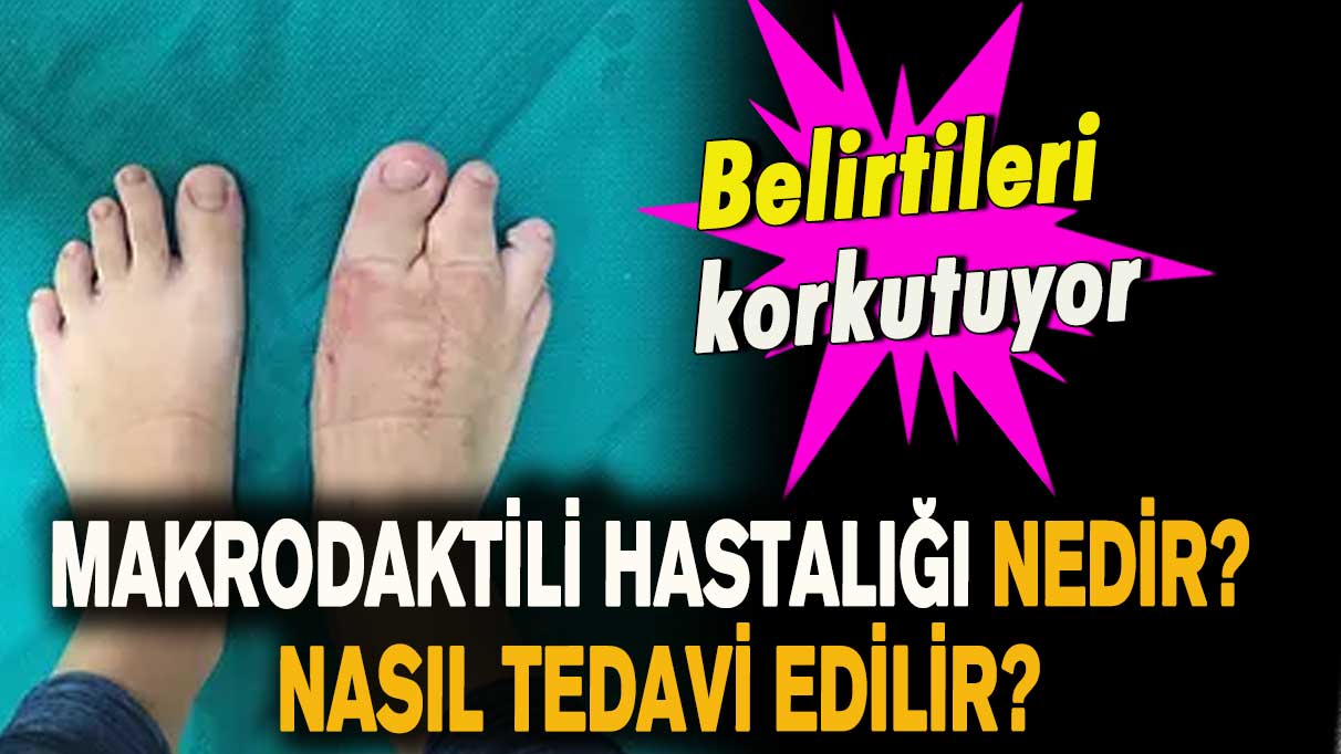 Makrodaktili hastalığı nedir? Nasıl tedavi edilir?