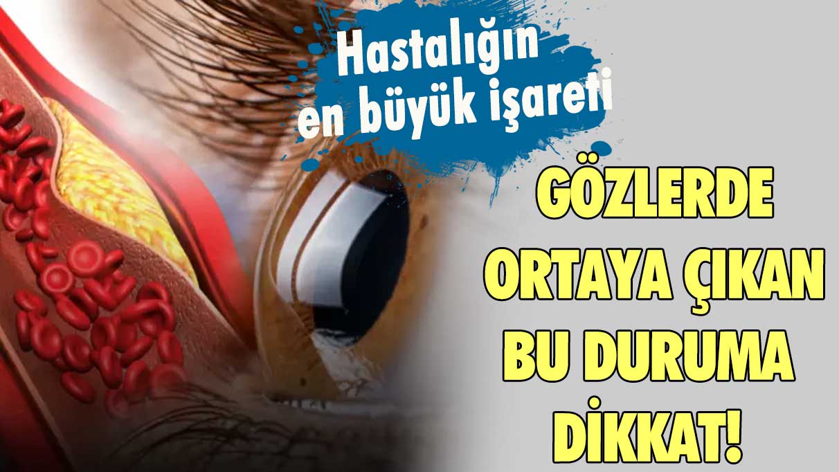 Gözlerde ortaya çıkan bu duruma dikkat! Hastalığın en büyük işareti