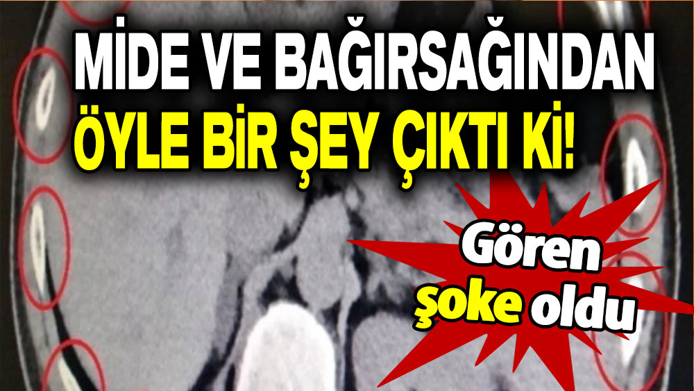 Mide ve bağırsağından öyle bir şey çıktı ki: Gören şoke oldu!