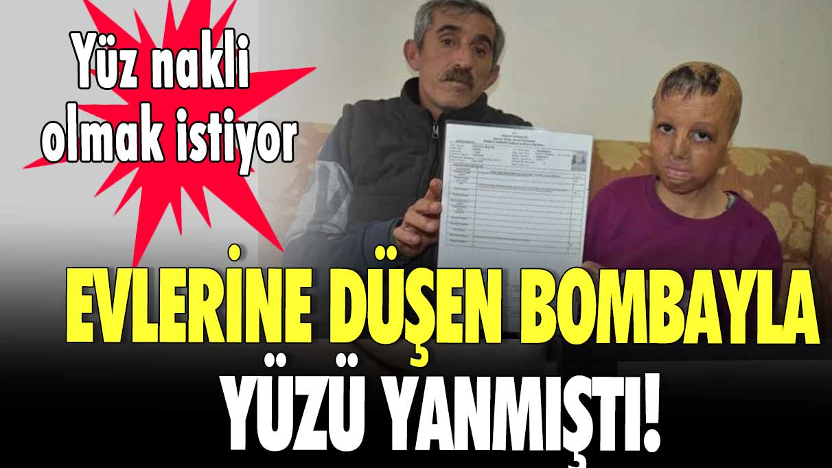 Evlerine düşen bombayla yüzü yanmıştı! Küçük kız yüz nakli olmak istiyor