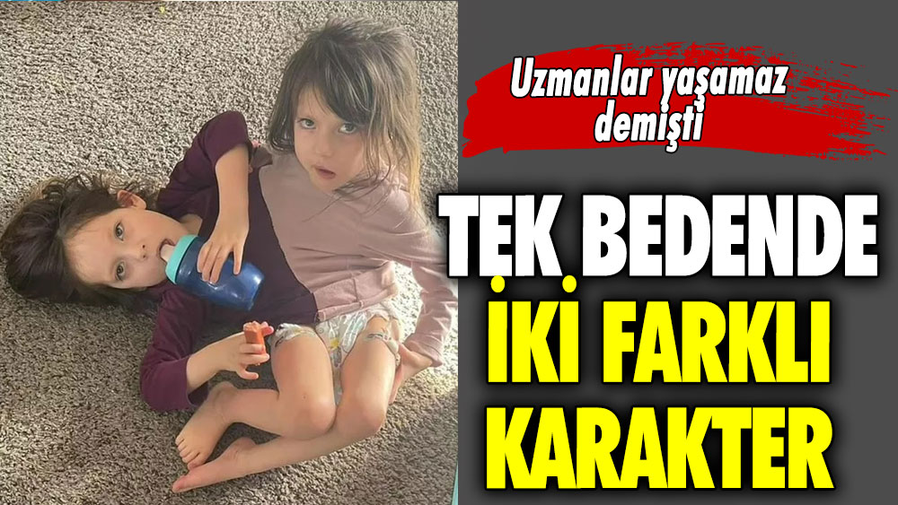 Tek bedende iki farklı karakter! Uzmanlar yaşamaz demişti