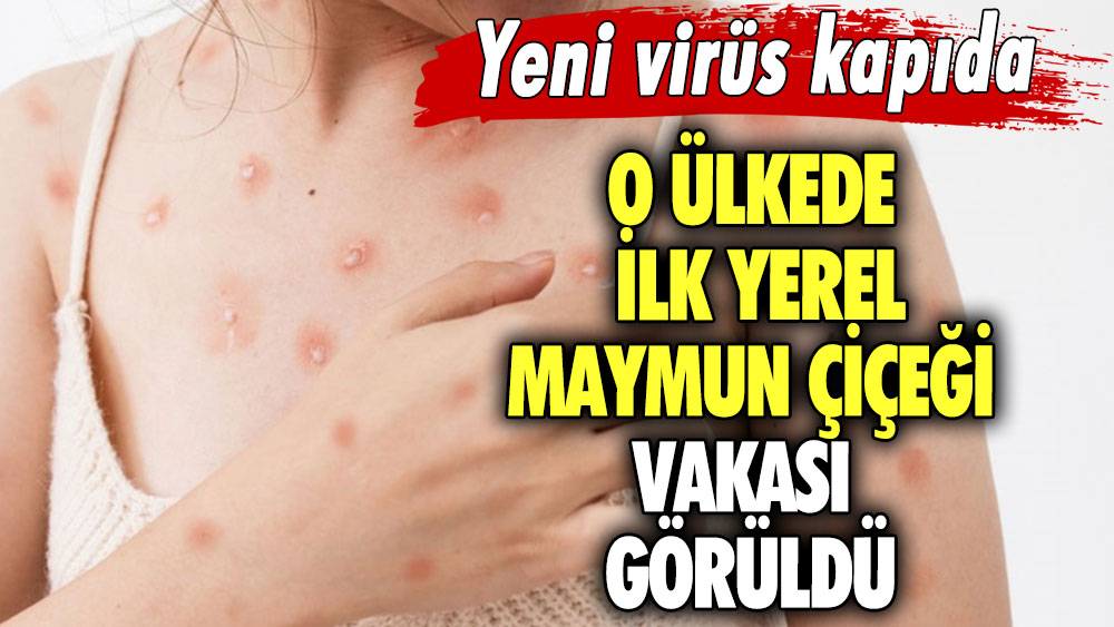 Yeni virüs kapıda! O ülkede ilk yerel maymun çiçeği vakası görüldü