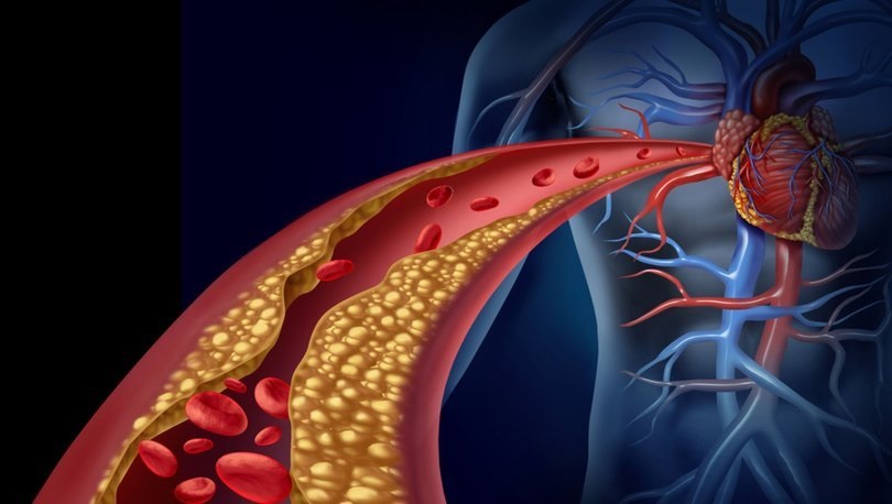 Kalp tıkanmalarına ameliyatsız çözüm