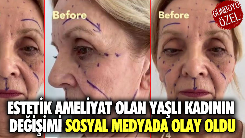 Estetik ameliyat olan yaşlı kadının değişimi sosyal medyada olay oldu