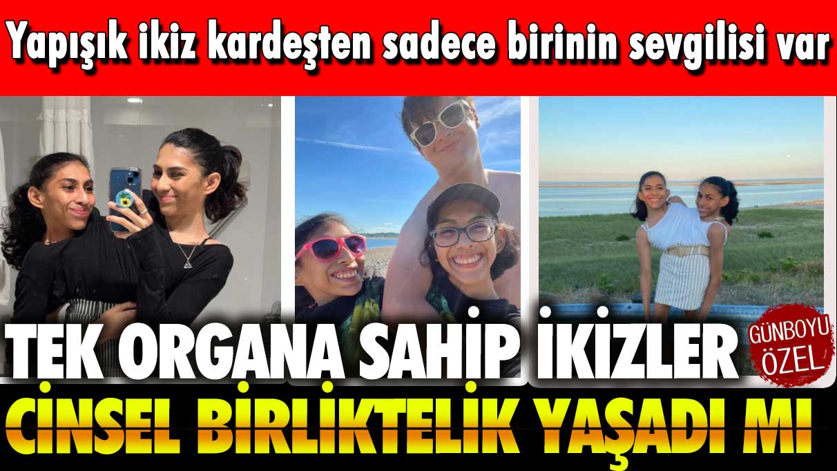 Yapışık ikiz kardeşten sadece birinin sevgilisi var: Tek organa sahip ikizler cinsel birliktelik yaşadı mı