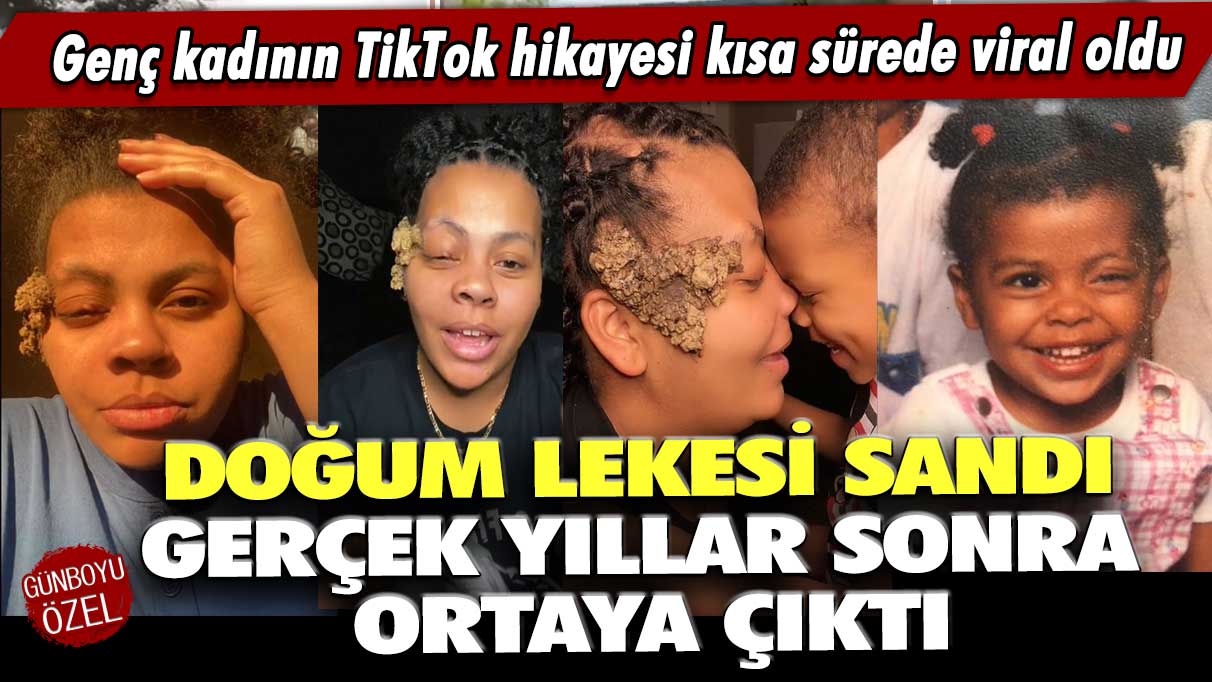 Doğum lekesi sandı ama gerçek yıllar sonra ortaya çıktı: Genç kadının TikTok hikayesi  kısa sürede viral oldu