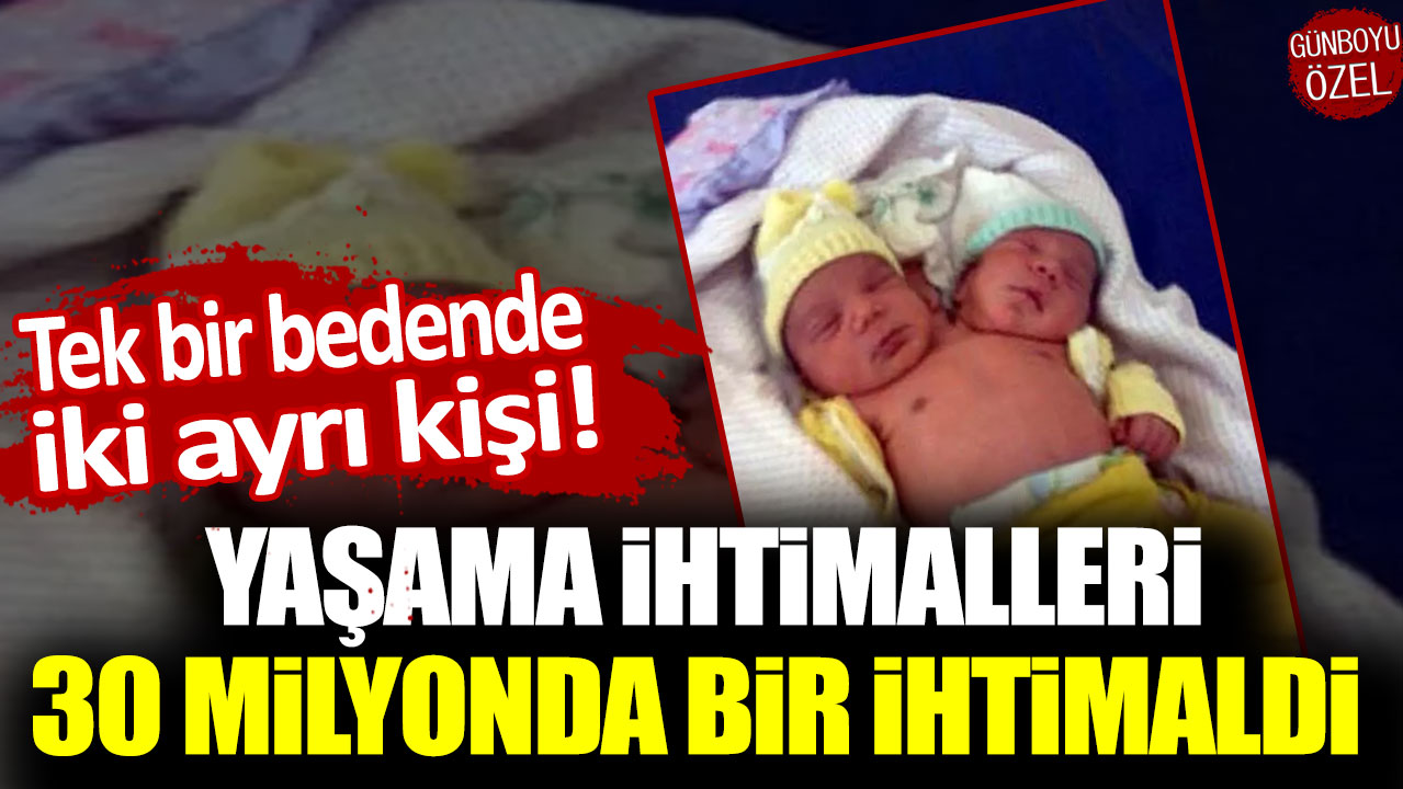 Tek bir bedende iki ayrı kişi! Yaşama ihtimalleri 30 milyonda bir ihtimaldi