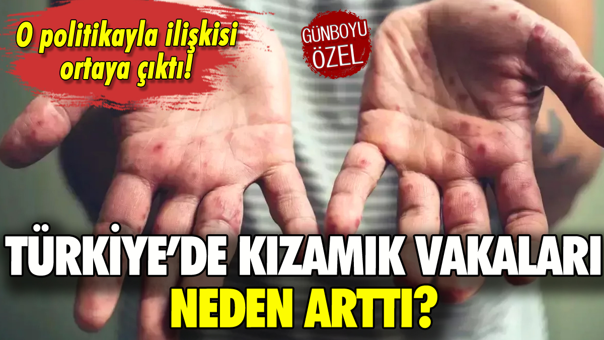 Türkiye'de kızamık vakaları neden arttı?