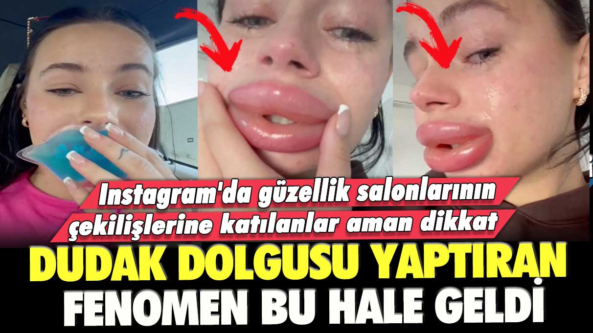 Instagram'da güzellik salonlarının çekilişlerine katılanlar aman dikkat: Dudak dolgusu yaptıran fenomen bu hale geldi