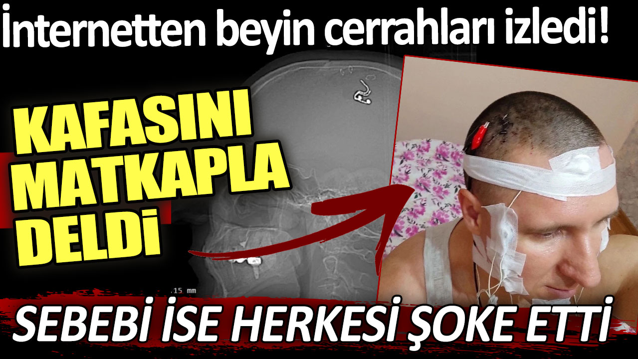 İnternetten beyin cerrahları izledi: Kafasını matkapla deldi! Sebebi herkesi şoke etti