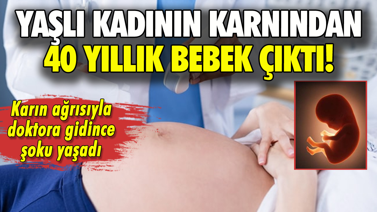 Yaşlı kadının karnından 40 yıllık ölü bebek çıktı!