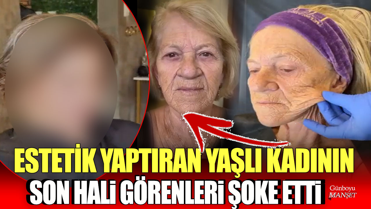 Estetik yaptıran yaşlı kadının son hali görenleri şoke etti