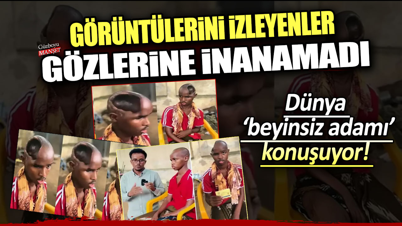 Dünya beyinsiz adamı konuşuyor! Görüntülerini izleyenler gözlerine inanamadı