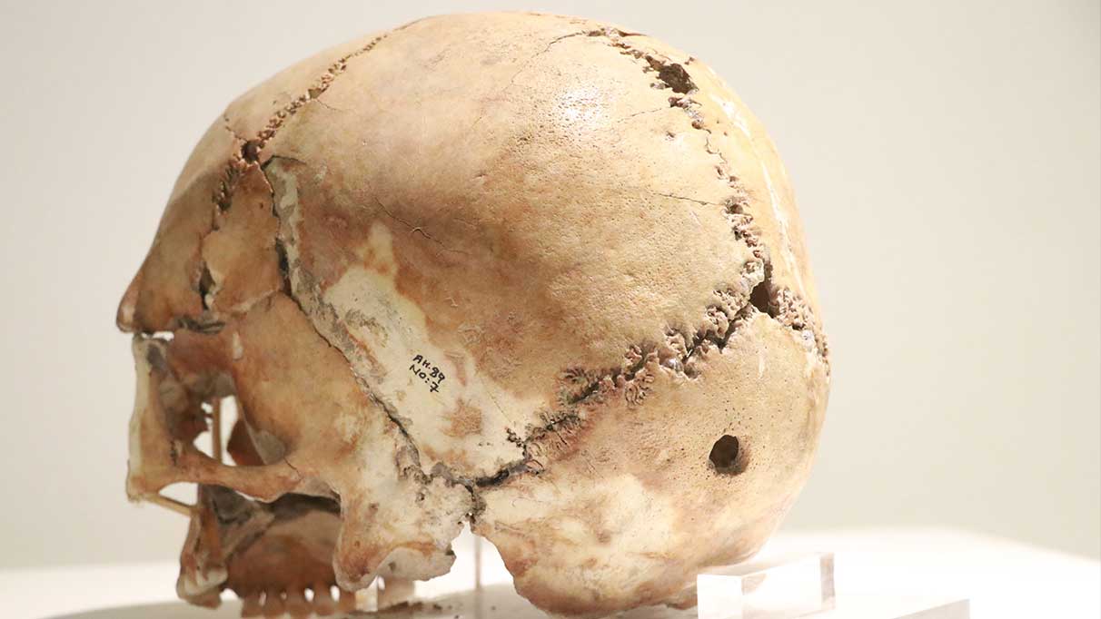 Dünyanın ilk beyin ameliyatına ait kafatası
