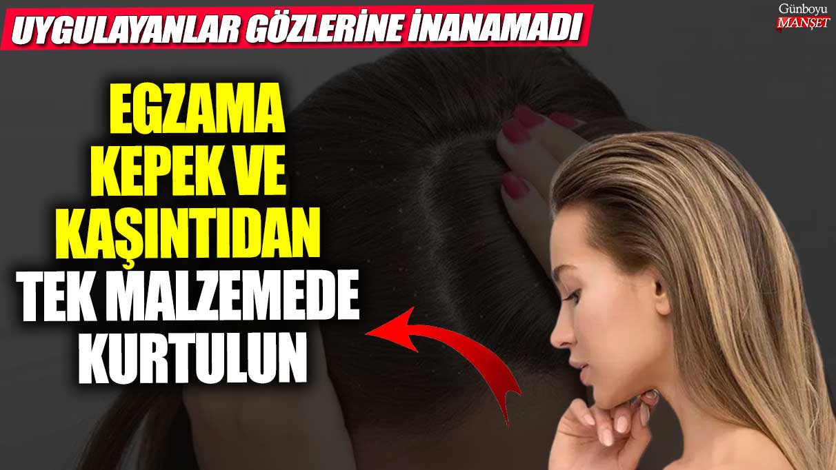 Egzama, kepek ve kaşıntıdan tek malzemeyle kurtulun!  Uygulayanlar gözlerine inanamadı