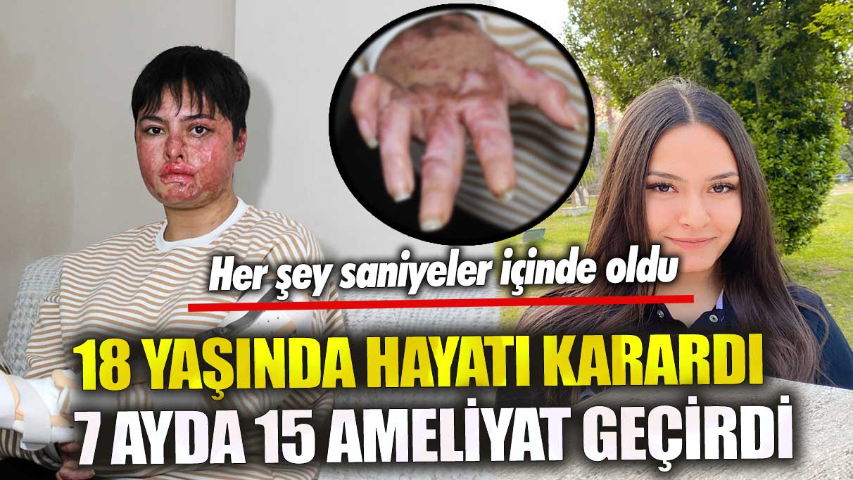 18 yaşında hayatı karardı 7 ayda 15 ameliyat geçirdi! Her şey saniyeler içinde oldu