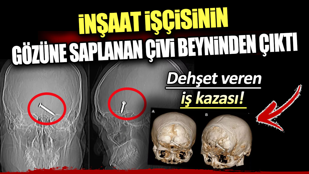 Malezya'da dehşet veren iş kazası! İnşaat işçisinin gözüne saplanan çivi, beyninden çıktı...