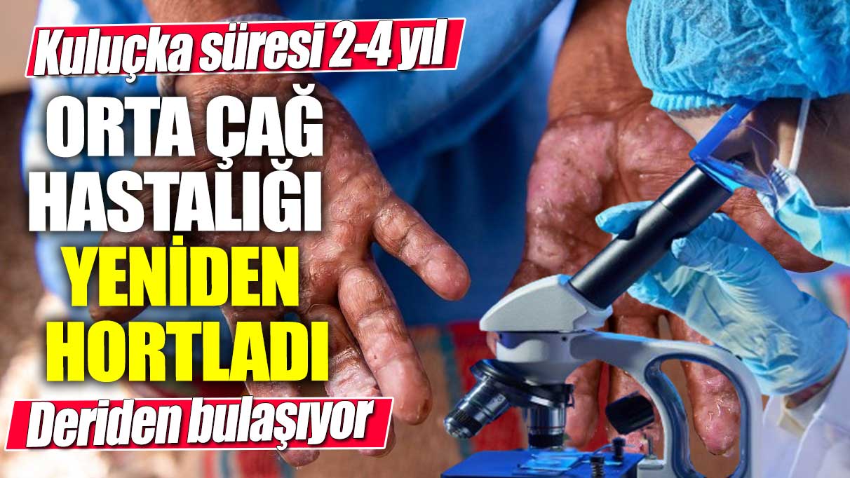 Orta Çağ hastalığı yeniden hortladı! Solunum yolu ve deriden bulaşıyor... Kuluçka süresi 2-4 yıl