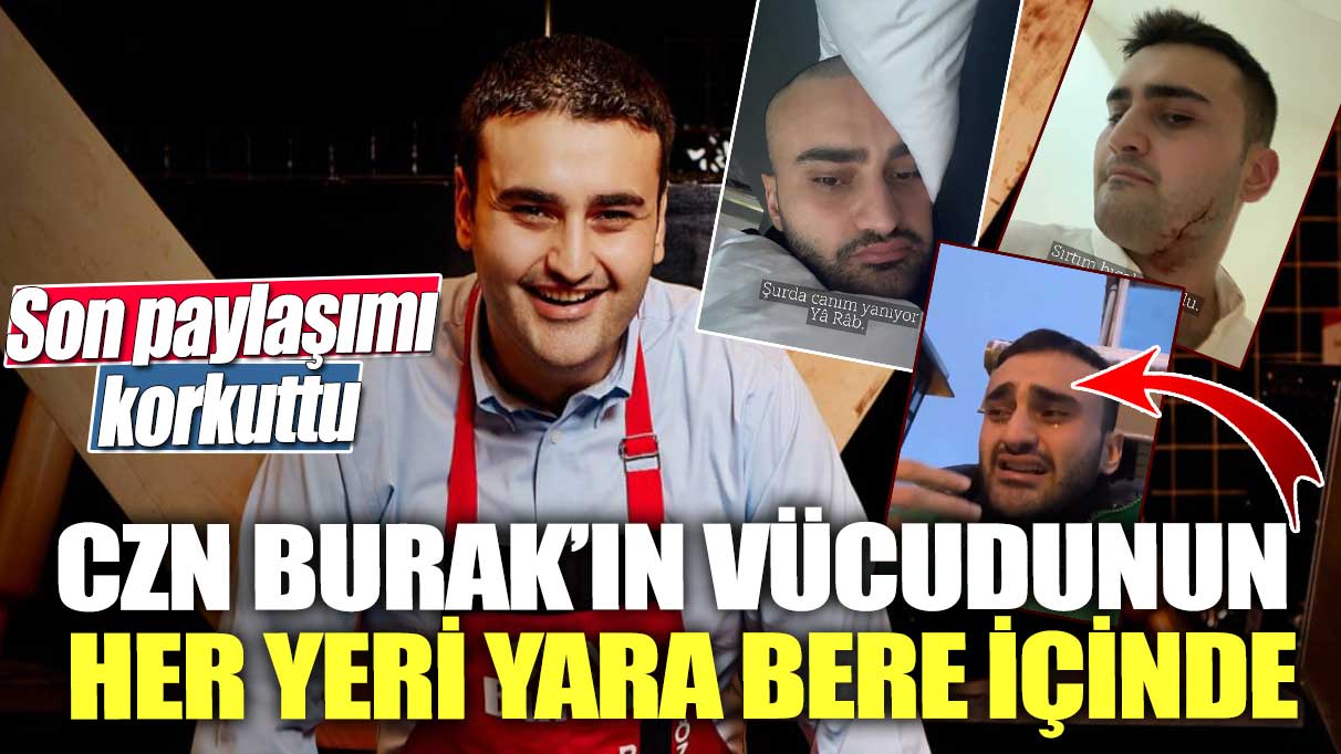 CZN Burak’ın vücudunun her yeri yara bere içinde! Son paylaşımı korkuttu