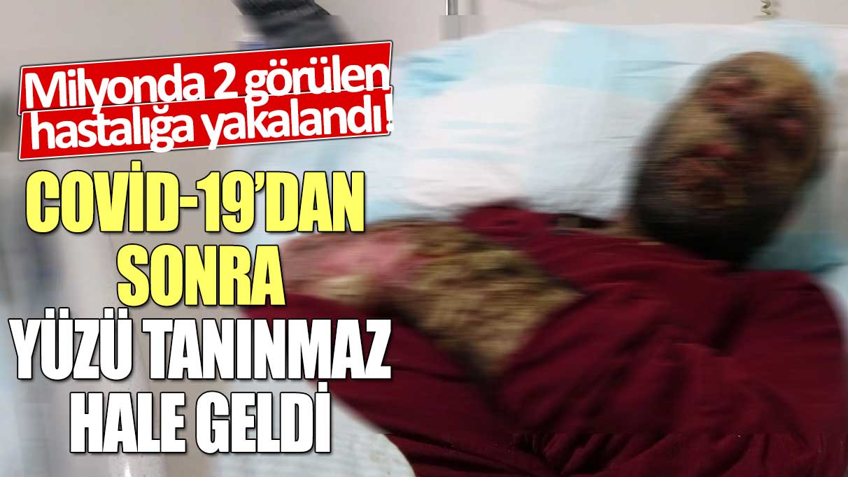 Milyonda 2 görülen hastalığa yakalandı!  Covid-19’dan sonra yüzü tanınmaz hale geldi