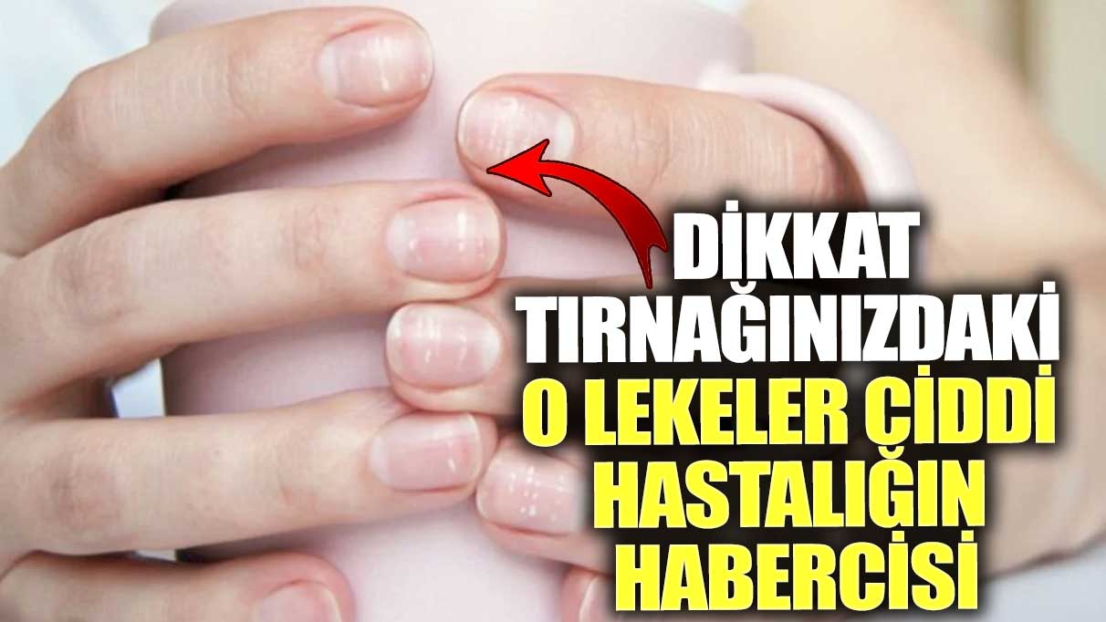 Dikkat tırnağınızdaki o lekeler ciddi hastalığın habercisi