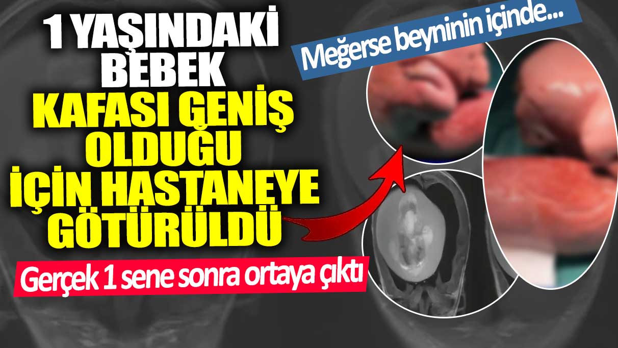 1 yaşındaki bebek kafası geniş olduğu için hastaneye götürüldü! Meğerse beyninin içinde...