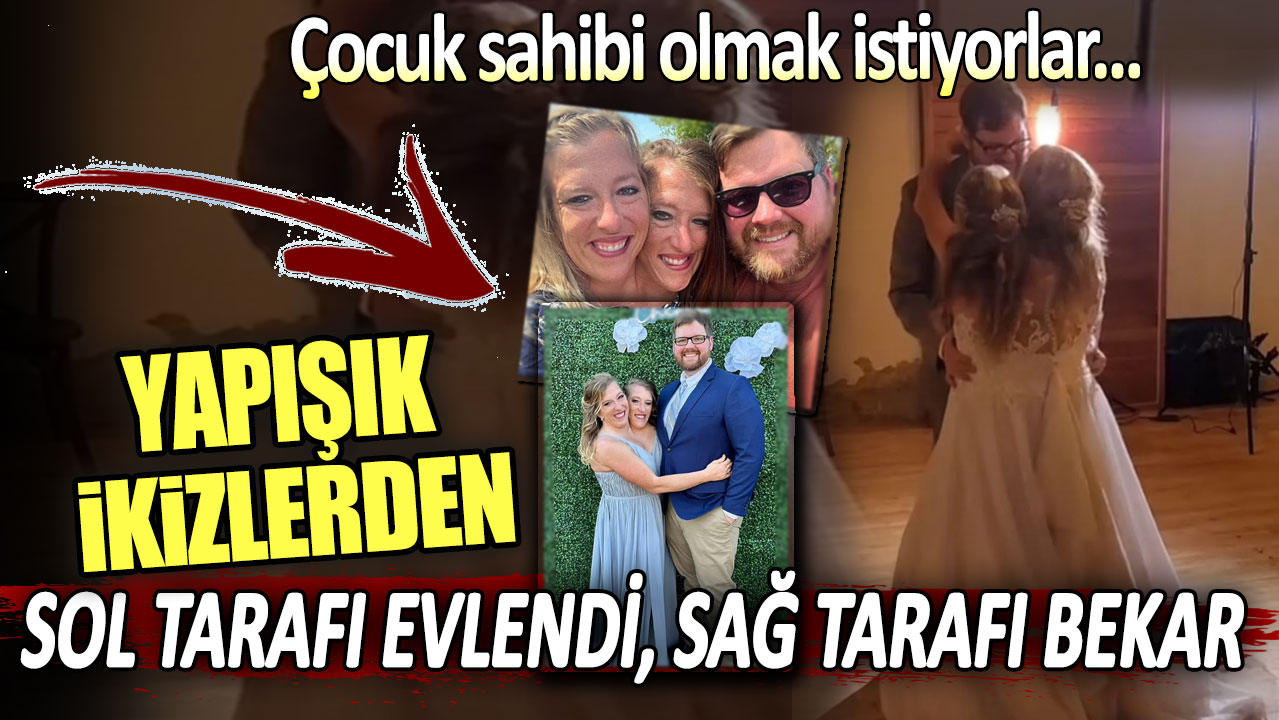 Yapışık ikizlerden sol tarafı evlendi, sağ tarafı bekar... Çocuk sahibi ...