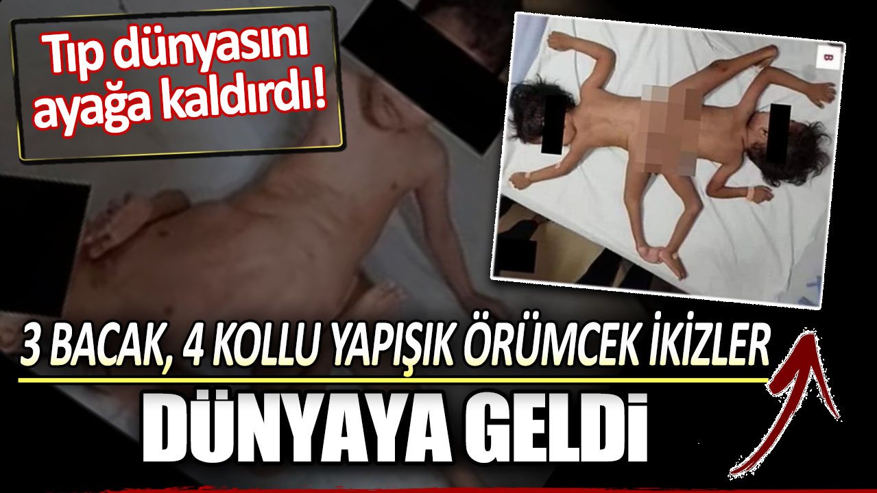 3 bacak, 4 kollu yapışık örümcek ikizler dünyaya geldi: Tıp dünyasını ayağa kaldırdı!