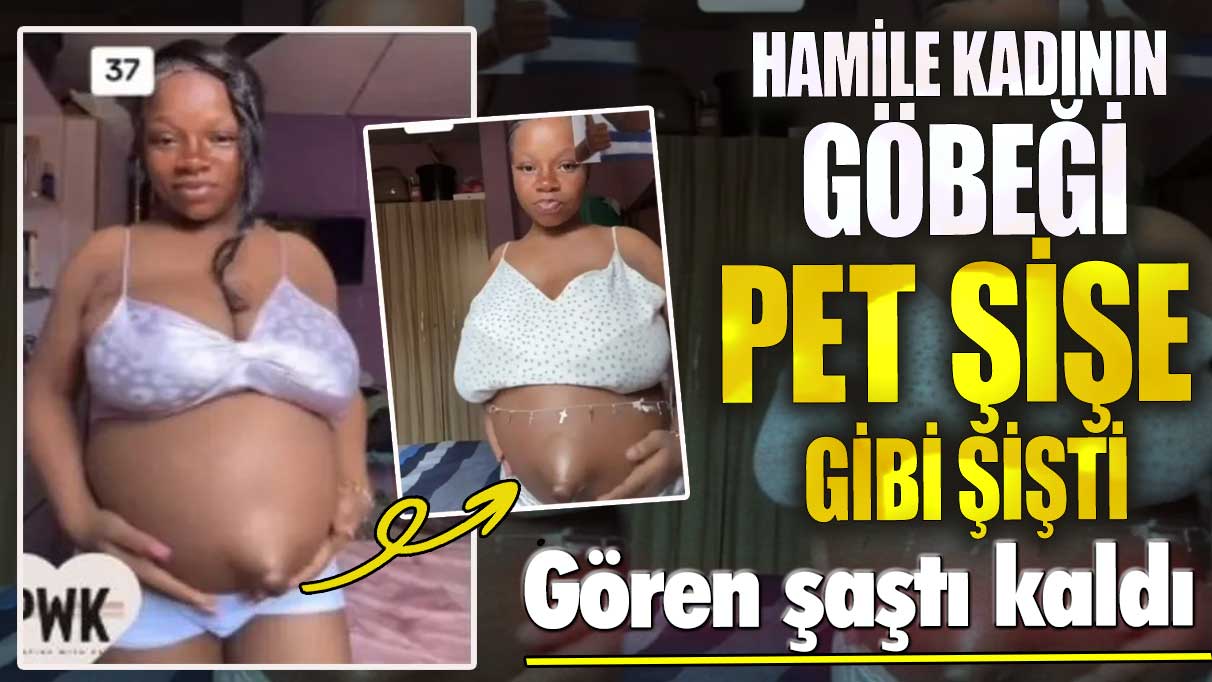 Hamile kadının göbeği pet şişe gibi şişti! Gören şaştı kaldı