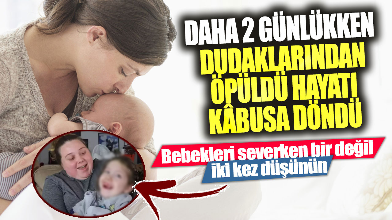 2 günlükken dudaklarından öpüldü hayatı kâbusa döndü!  Bebekleri severken bir değil iki kez düşünün