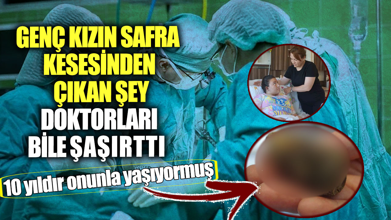 10 yıldır onunla yaşıyormuş! Genç kızın safra kesesinden çıkan şey doktorları bile şaşırttı