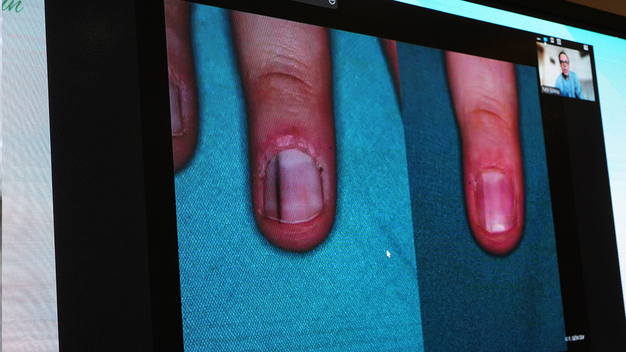 Tırnak dibinde görülen siyah leke yoksa kanser belirtisi mi?