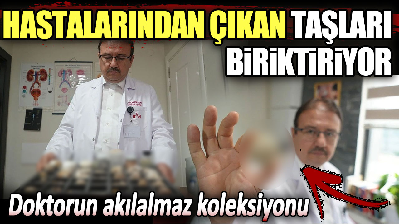 Uzman doktorun akılalmaz koleksiyonu. Hastalarından çıkan taşları biriktiriyor