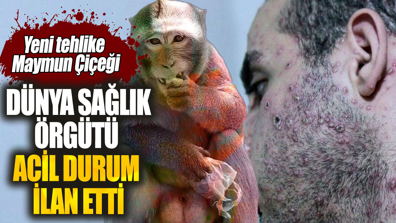 Dünya Sağlık Örgütü acil durum ilan etti! Yeni tehlike Maymun Çiçeği hastalığı