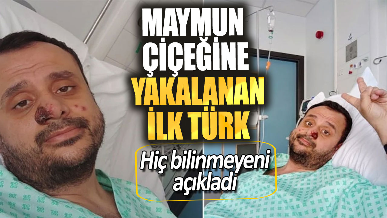 Maymun çiçeğine yakalanan ilk Türk!  Hiç bilinmeyeni açıkladı