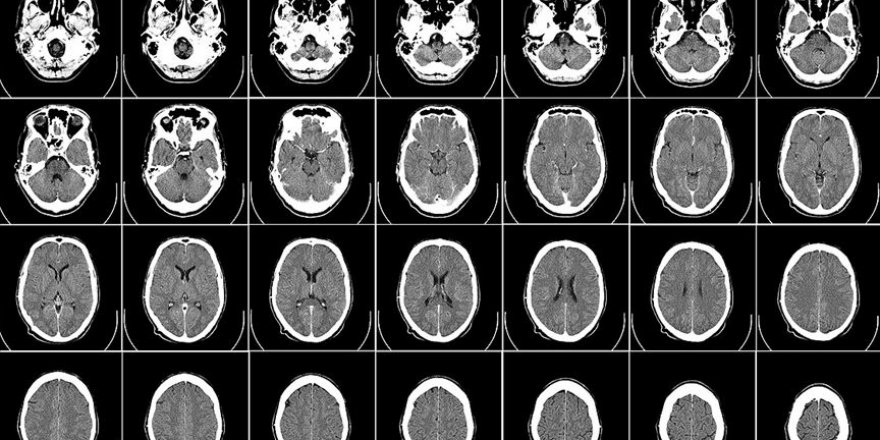 Obez çocukların beyinlerinde yapısal farklılıklar gözlendi