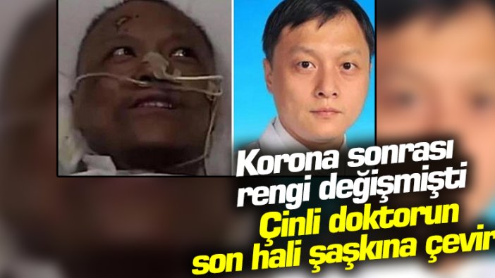 Korona virüs sonrası rengi değişen Çinli doktor normale döndü