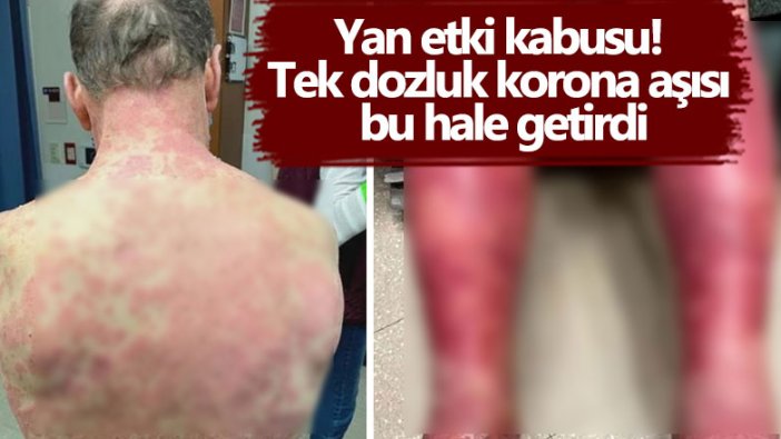 Yan etki kabusu! Tek dozluk korona aşısı bu hale getirdi