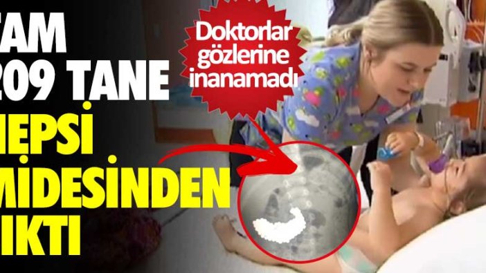 Doktorlar gözlerine inanamadı! Tam 209 tane midesinden çıktı