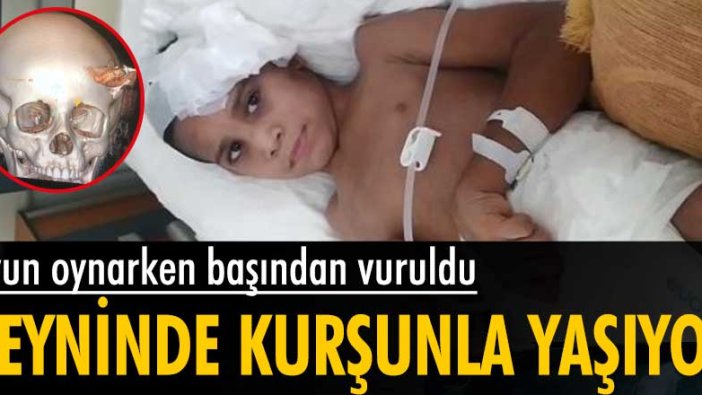 75 gündür başına isabet eden kurşunla yaşıyor