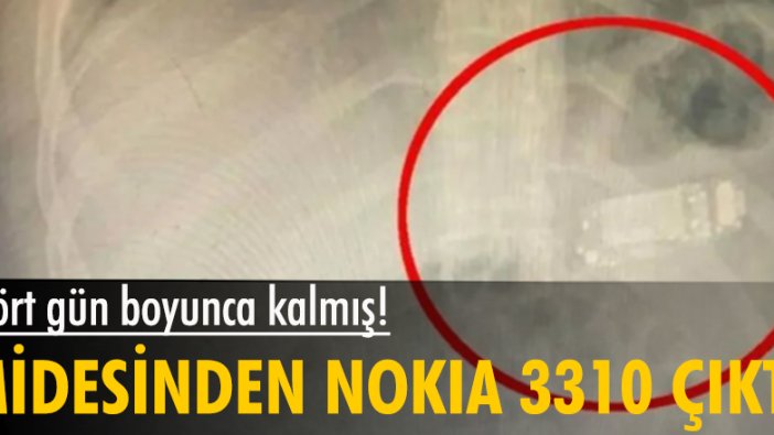 Priştine'de bir adamın midesinden Nokia 3310 çıkarıldı