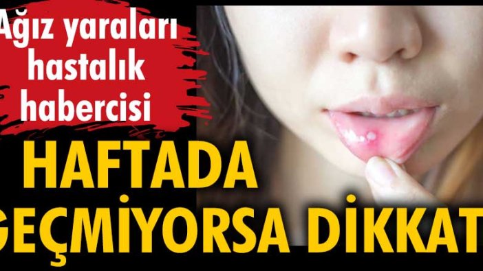 Ağız yaraları 1 haftada geçmiyorsa dikkat!