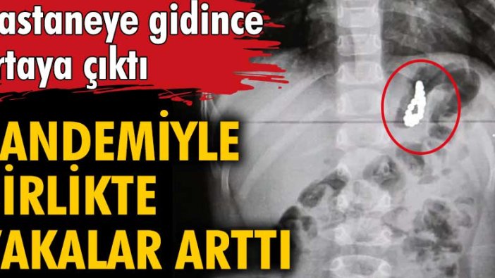 Pandemiyle birlikte çocuklarda yabancı cisim yutma vakası arttı