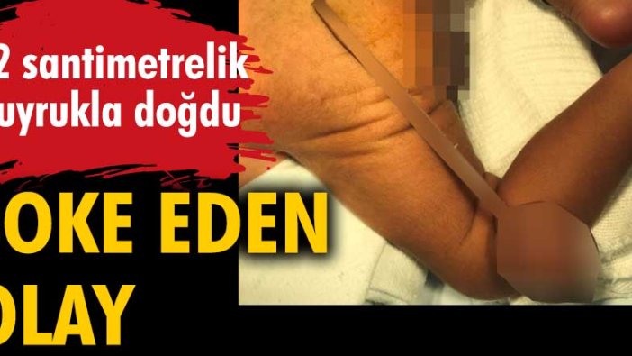 Şoke eden olay! 12 santimetrelik kuyrukla doğdu