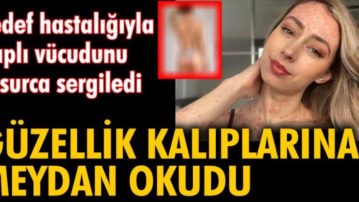 Sedef hastalığıyla kaplı vücudunu cesurca sergiledi